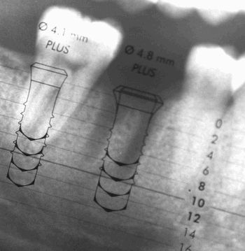 Implants Hongrie